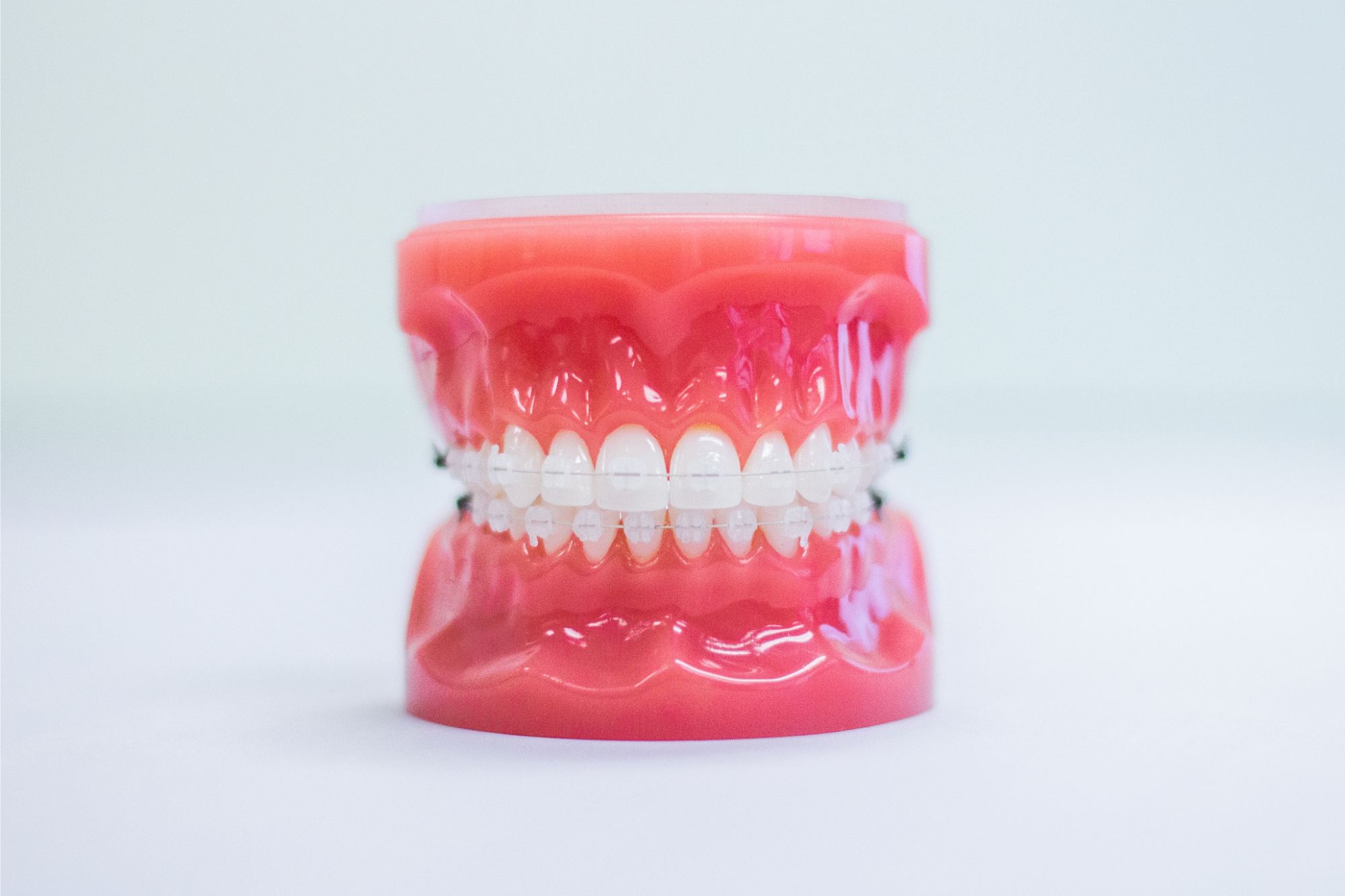 Orthodontics - Ceramic Braces