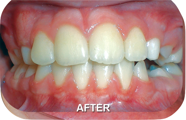Orthodontics Treatment Class II Division After