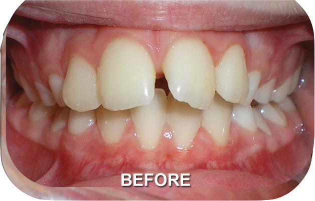 Orthodontics Treatment Class II Division Before