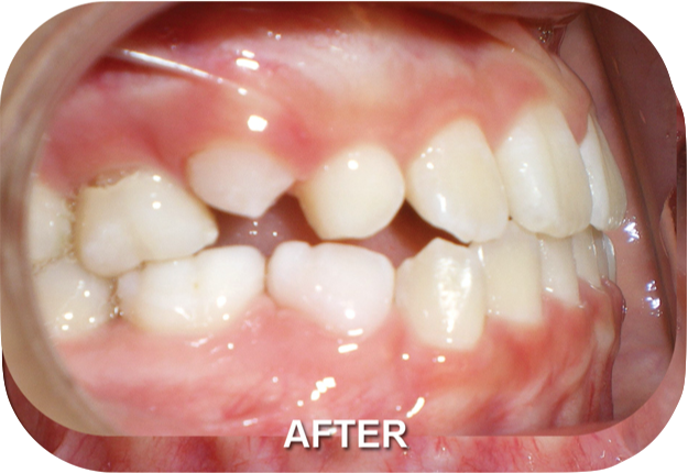 Orthodontics Treatment Class III Skeletal After