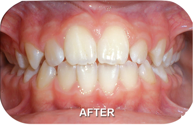 Orthodontics Treatment Skeletal Open Bite After