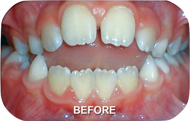 Orthodontics Treatment Skeletal Open Bite Before